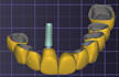do crown and veneer design