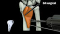 create 3d medical animation, surgical animation, surgery animation video