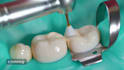 create dental implant animation caries removal and dental device explainer video