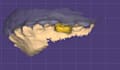 design dental crowns and bridges