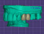 design dental crowns and bridges in exocad