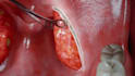 create 3d medical animation surgery medical device and anatomy device procedure