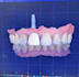 design crowns, bridges and implants professionally in exocad