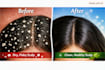 formulate effective antidandruff free sulfate shampoo