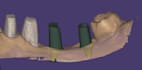 design custom abutments and full arch implant restorations
