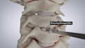 do 3d cervical disc replacement spine surgery animation and medical explainer