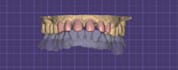 design natural looking dental veneers
