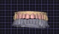 design custom exocad anterior smile makeovers and full arch restorations