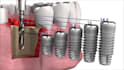 create 3d dental implant surgery and medical animation