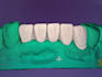 expert dental design on exocad crowns, bridge and more