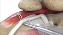 create 3d surgical procedure, medical device and anatomy visualization video