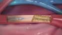 create 3d cardiovascular medical device animation, stent and catheter explainer