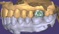 design aesthetic dental crown veneers and bridges using exocad