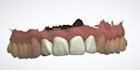 design anterior and posterior dental crowns using 3shape