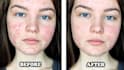 remove pimples and blemishes