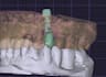 make your dental implant crown design