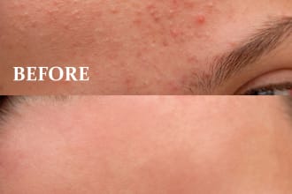 remove your acne marks, pimples, dark circles, and eye bags
