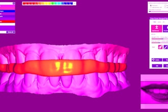 design michigan splints and retainers