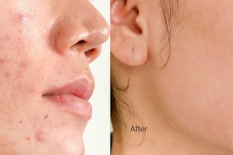 remove acne, blemishes, and repair old image efficiently