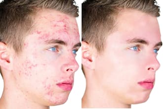 professionally acne pimples on skin and do smooth face