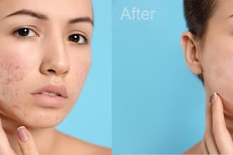 remove pimples from your images