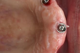design full implant arch using exocad and 3 shape