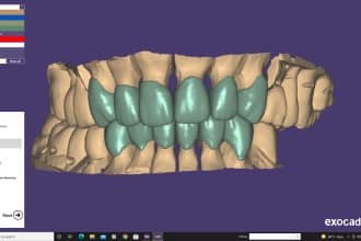 design crown bridge and dental restorations in exocad