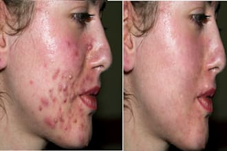 remove acne from up to 5 photos