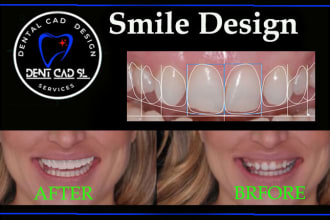 design   smile design, mockup, snap on smile  with exocad