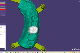design crown bridge and dental restorations in exocad