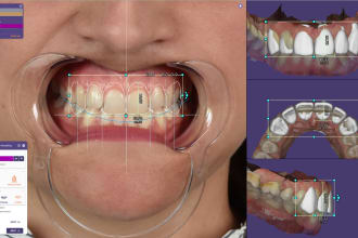 do digital smile design project for a perfect smile transformation