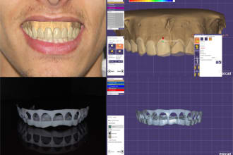 design prep guide or gingivectomy guide for your dental practice