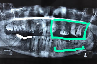 professional 2nd opinion , diagnosis , plan for panoramic dental image