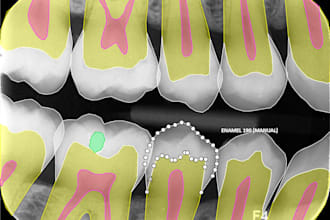 precisely annotate dental x ray images for your ai