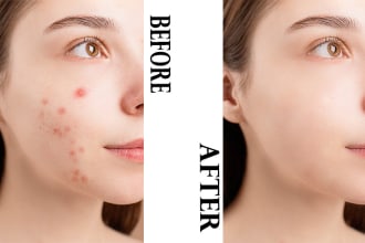 retouch your skin , remove acne and pimples professionally