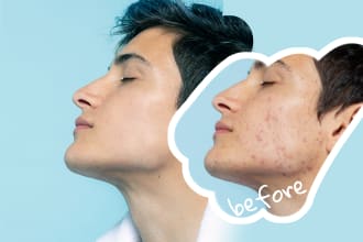 retouch skin, remove pimples, acne, skin tone, reduce redness