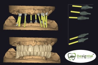 do master crafted dental design for implantwork like allonx