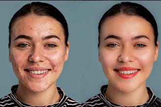 remove pimples marks and dark spots your face