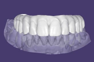 do implant crowns and bridges on exocad
