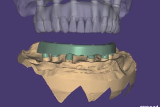 do bars in exocad for zirconium zr superstructures