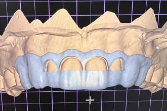 design gingivectomy and bone reduction guide in one in exocad