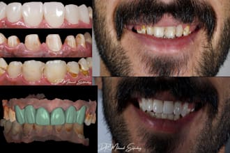 make dental designs on exocad crown x bridge  x implant bar