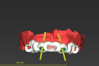 design dental implant planning, surgical guides and 3d models from cbct data