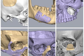 oral and maxillofacial implant designing