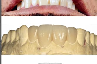 design dental crowns, bridge, implant crown dentures