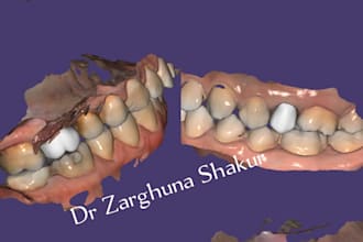 design crowns and bridges in exocad