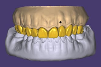 design crowns and bridges using exocad