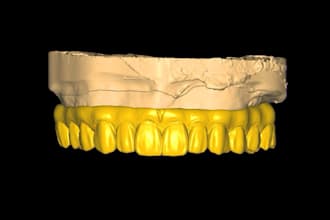 design crowns, bridges, implants in premium quality using exocad