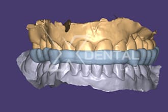 bite splint for tmd and bruxism in exocad