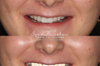 design precise dental cad models using exocad